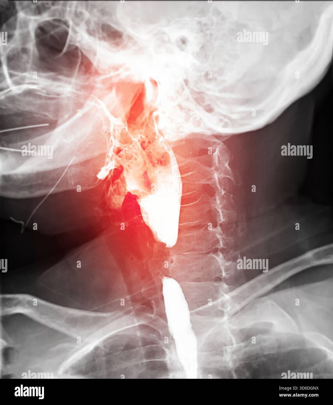 Radiographie de l'œsophage supérieur, montrant une fonction de déglutition normale sans signe d'obstruction ou d'anomalie dans la région de la gorge. Banque D'Images