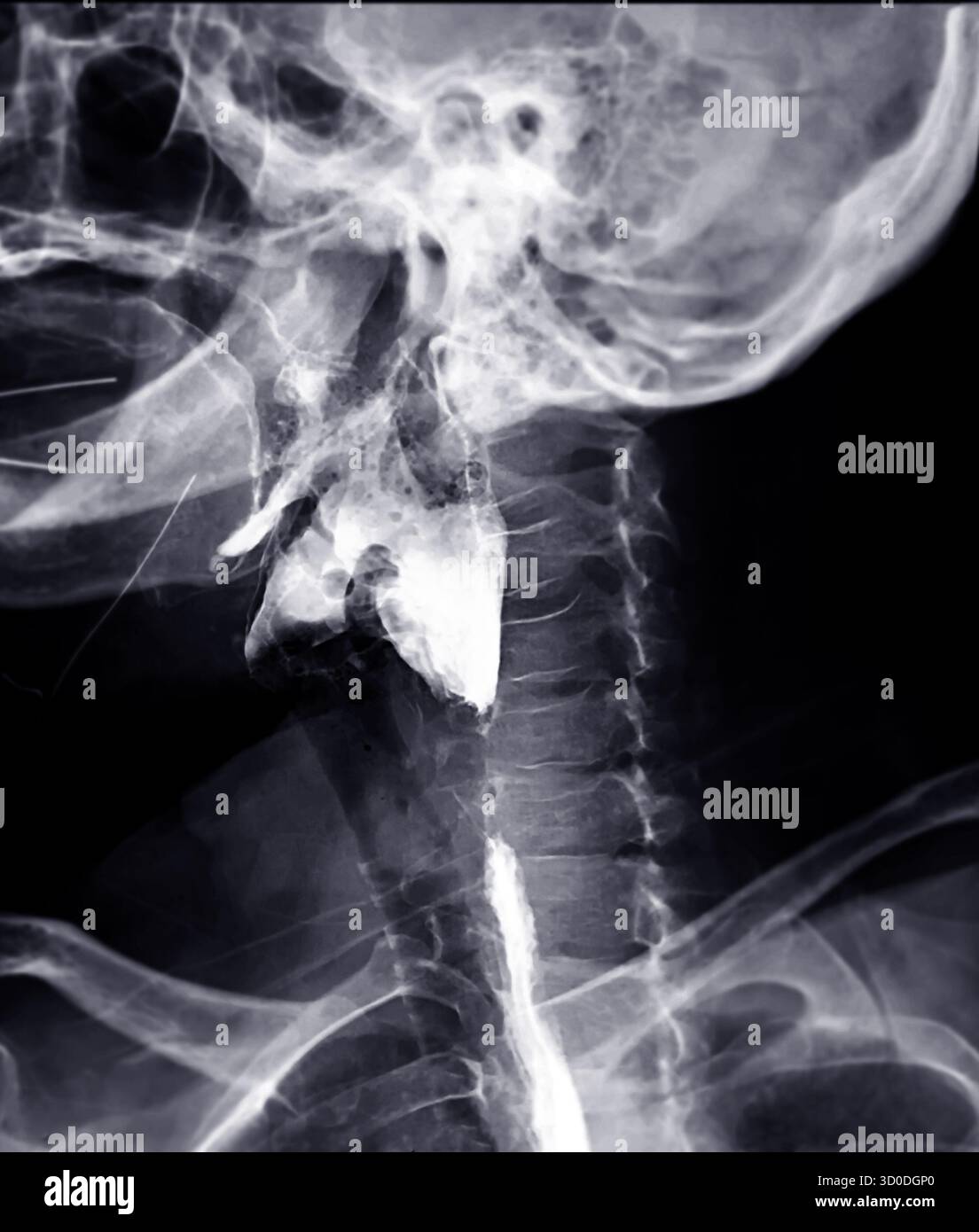 Radiographie de l'œsophage supérieur, montrant une fonction de déglutition normale sans signe d'obstruction ou d'anomalie dans la région de la gorge. Banque D'Images