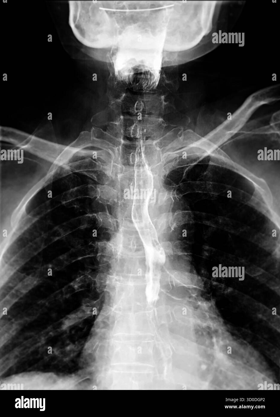 Radiographie de l'œsophage supérieur, montrant une fonction de déglutition normale sans signe d'obstruction ou d'anomalie dans la région de la gorge. Banque D'Images