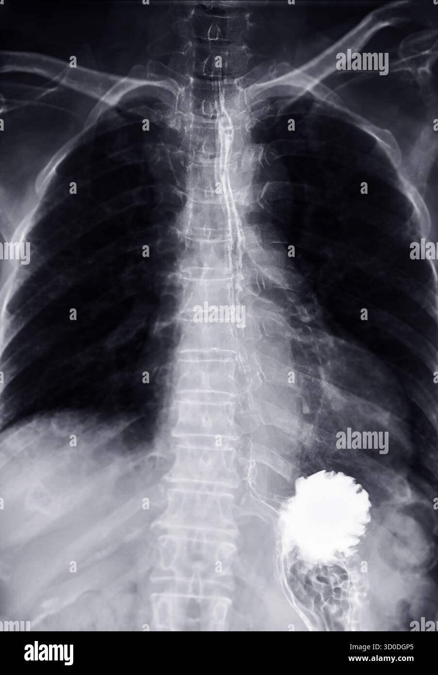 Radiographie de l'œsophage supérieur, montrant une fonction de déglutition normale sans signe d'obstruction ou d'anomalie dans la région de la gorge. Banque D'Images