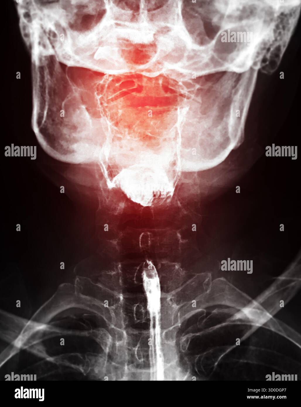 Radiographie de l'œsophage supérieur, montrant une fonction de déglutition normale sans signe d'obstruction ou d'anomalie dans la région de la gorge. Banque D'Images