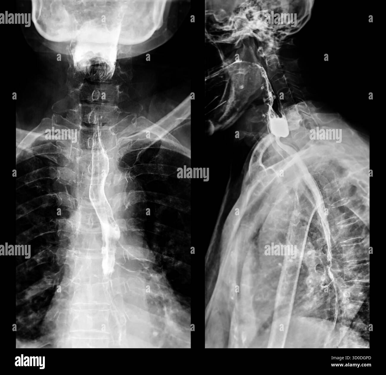 Radiographie de l'œsophage supérieur, montrant une fonction de déglutition normale sans signe d'obstruction ou d'anomalie dans la région de la gorge. Banque D'Images