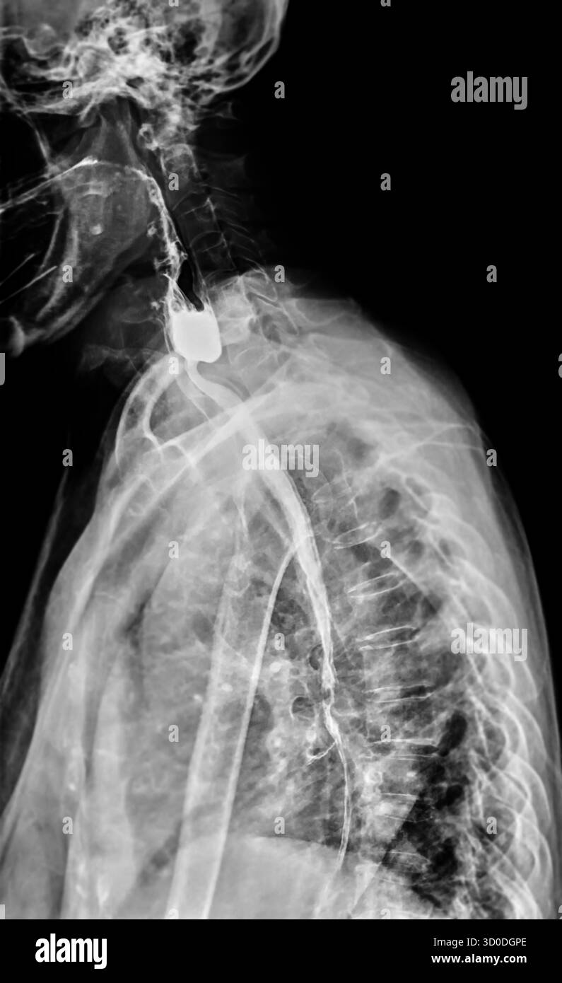 Radiographie de l'œsophage supérieur, montrant une fonction de déglutition normale sans signe d'obstruction ou d'anomalie dans la région de la gorge. Banque D'Images