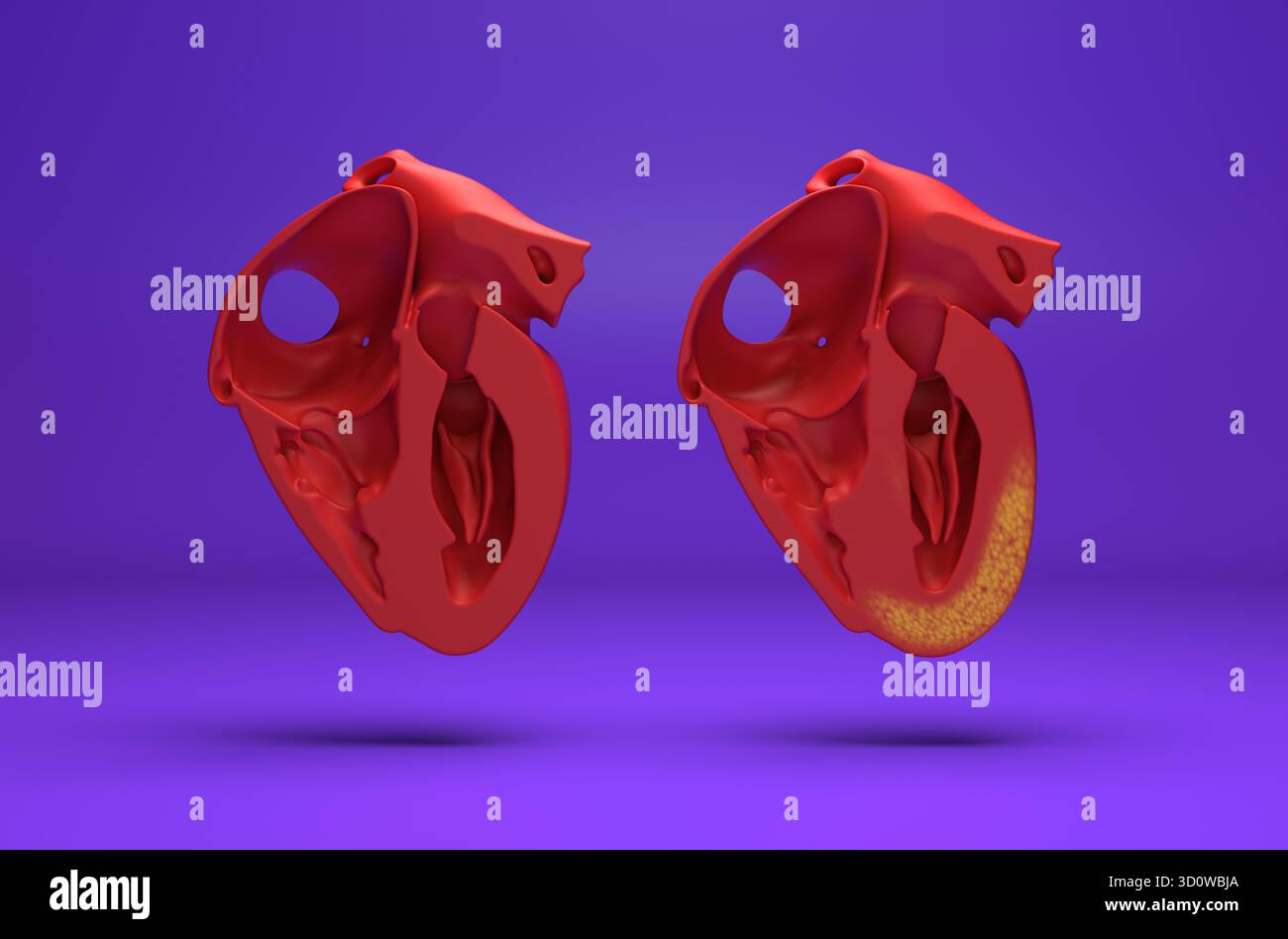 Myocardite - vue isométrique de l'illustration 3D. Banque D'Images
