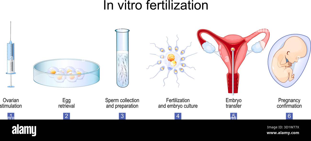 Fécondation. Étapes de la procédure de fiv. Stimulation ovarienne, prélèvement d'oeufs, collecte et préparation de spermatozoïdes, fécondation et culture d'embryons, embryon Illustration de Vecteur