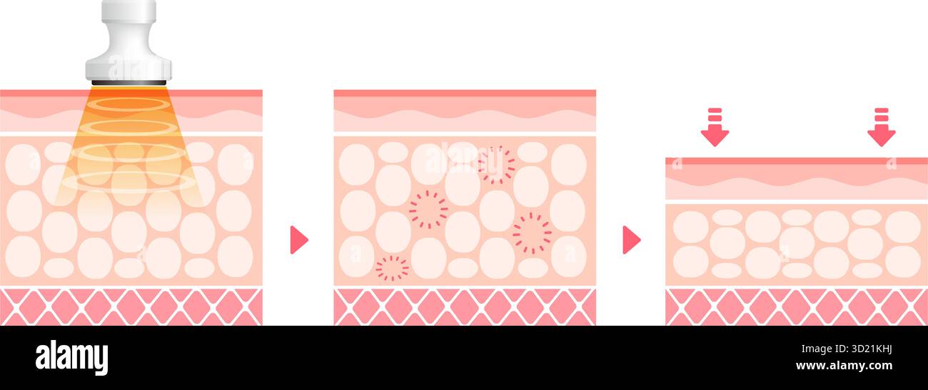 Illustration vectorielle du fonctionnement de la cavitation Illustration de Vecteur