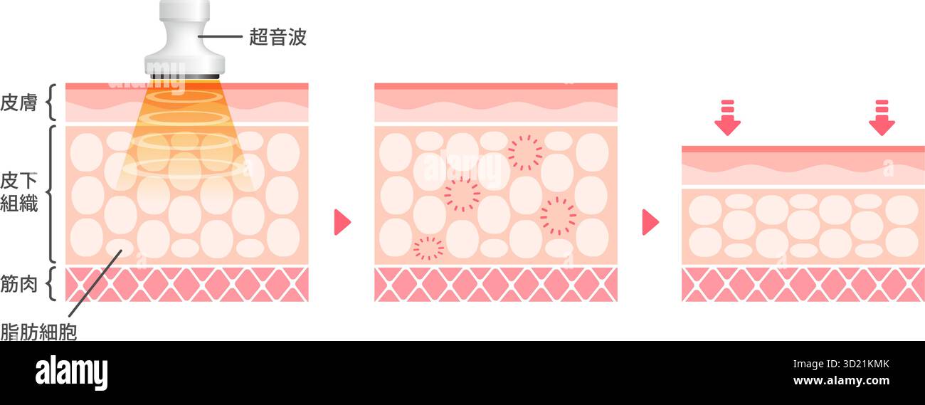 Illustration vectorielle du fonctionnement de la cavitation Illustration de Vecteur
