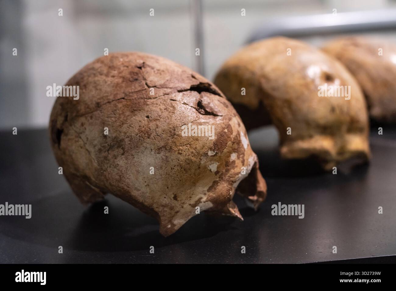 Crâne avec trou traumatique. Période néolithique., Musée diocésain et régional de Solsona, Lleida, Catalogne, Espagne. Banque D'Images