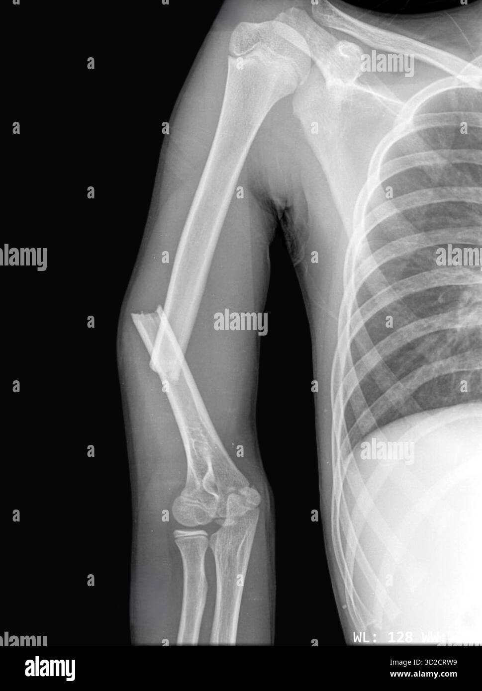Radiographie d'un humérus fracturé (os du bras supérieur). Banque D'Images