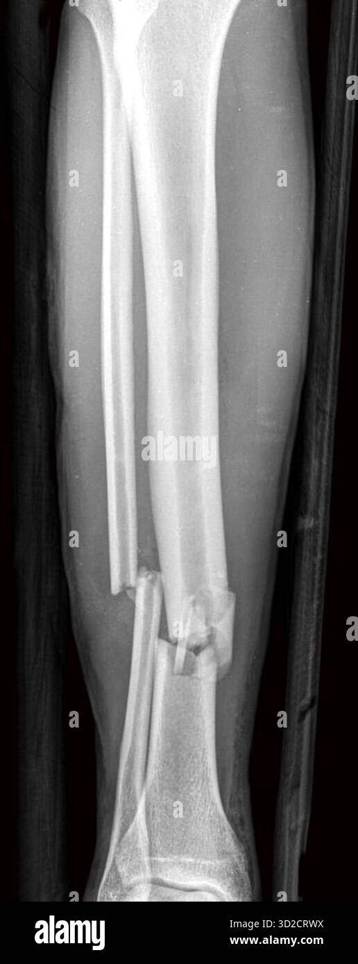 Radiographie des fractures du tibia (tibia) et du péroné (os du mollet). Banque D'Images