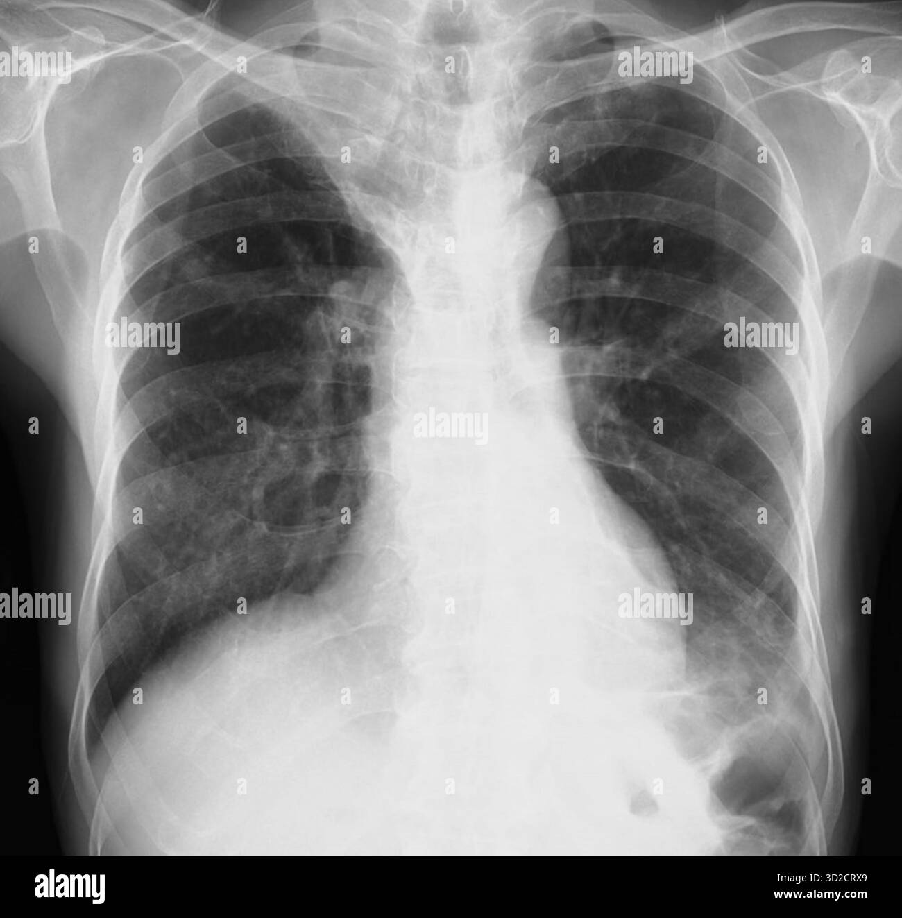 Poumon affaissé. Radiographie thoracique montrant une atélectasie pulmonaire dans le lobe supérieur droit (collapsus). Banque D'Images