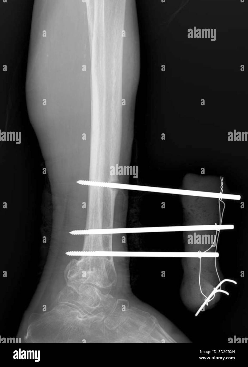 Radiographie d’une jambe fracturée qui a été fixée extérieurement pour stabiliser les os et favoriser la cicatrisation. Banque D'Images