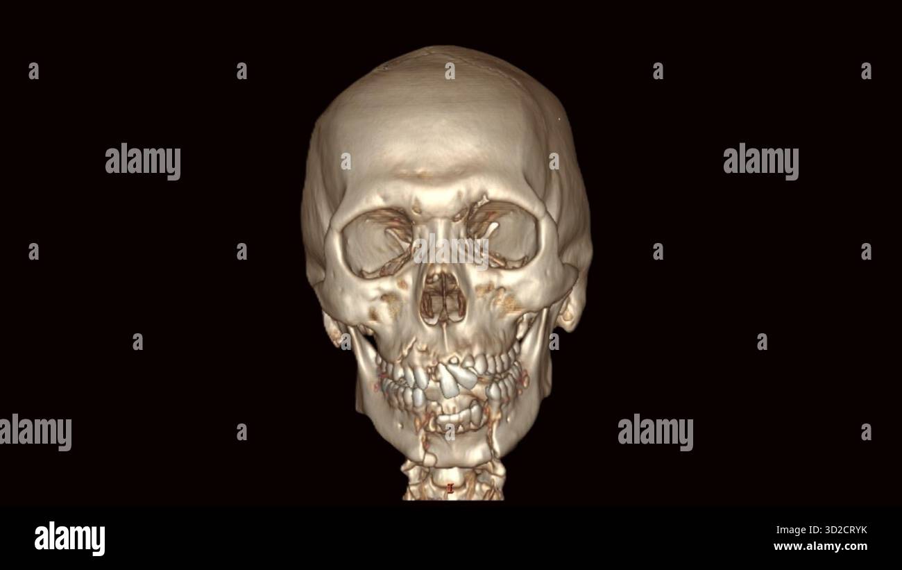 Tomodensitométrie 3D couleur d'une mâchoire inférieure fracturée (mandibule). Banque D'Images