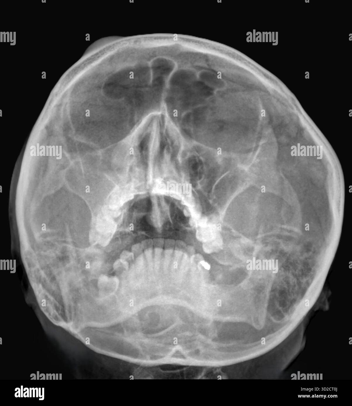 Radiographie du visage d'un patient atteint de sinusite droite, montrant des opacités (blanches) dans le sinus maxillaire droit (centre gauche). Banque D'Images