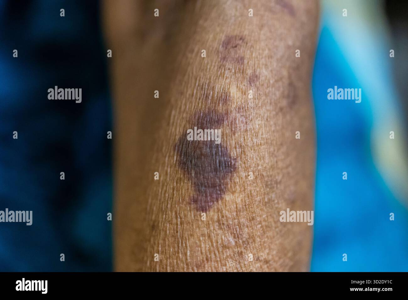 allergie cutanée en gros plan d'un avant-bras âgé avec ecchymose violet foncé visible et petites taches rouges Banque D'Images