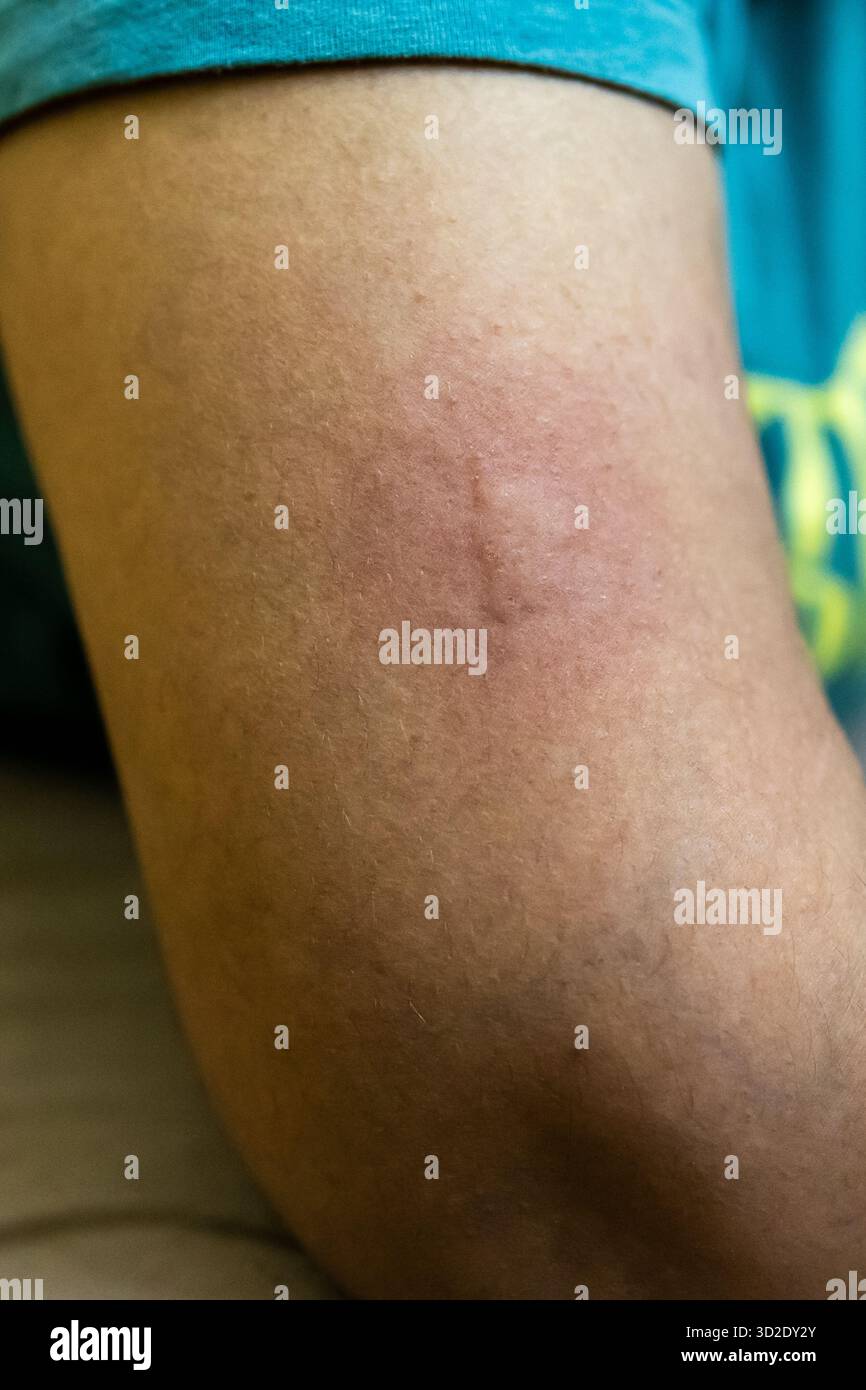peau douloureuse et sensible due à une piqûre de moustique Banque D'Images