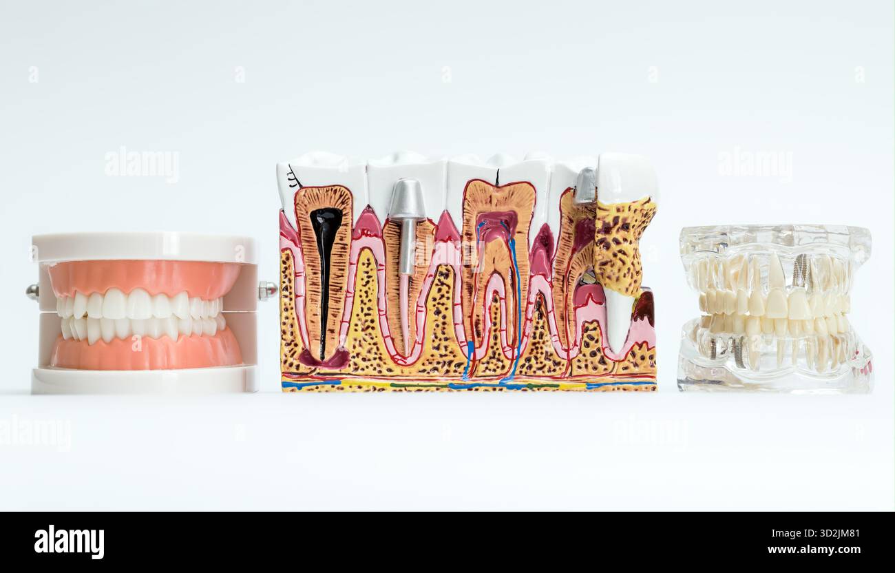 Trois modèles dentaires éducatifs : prothèse complète, anatomie dentaire transversale avec carie et implants, et mâchoire transparente avec restaurations. Banque D'Images