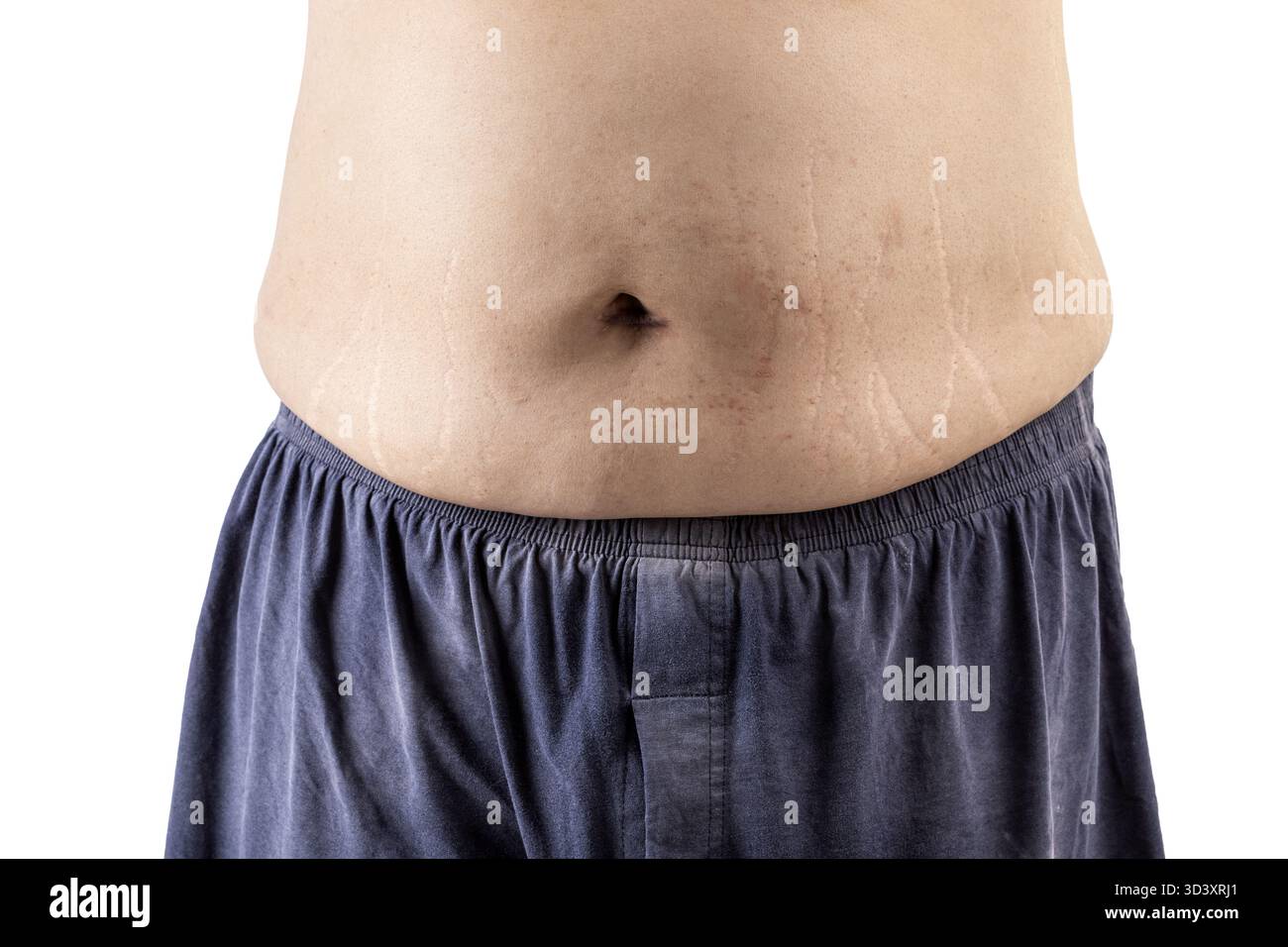 Une personne montrant son ventre avec des vergetures visibles, portant un short bleu. l'image met en évidence la texture de la peau et la positivité du corps Banque D'Images