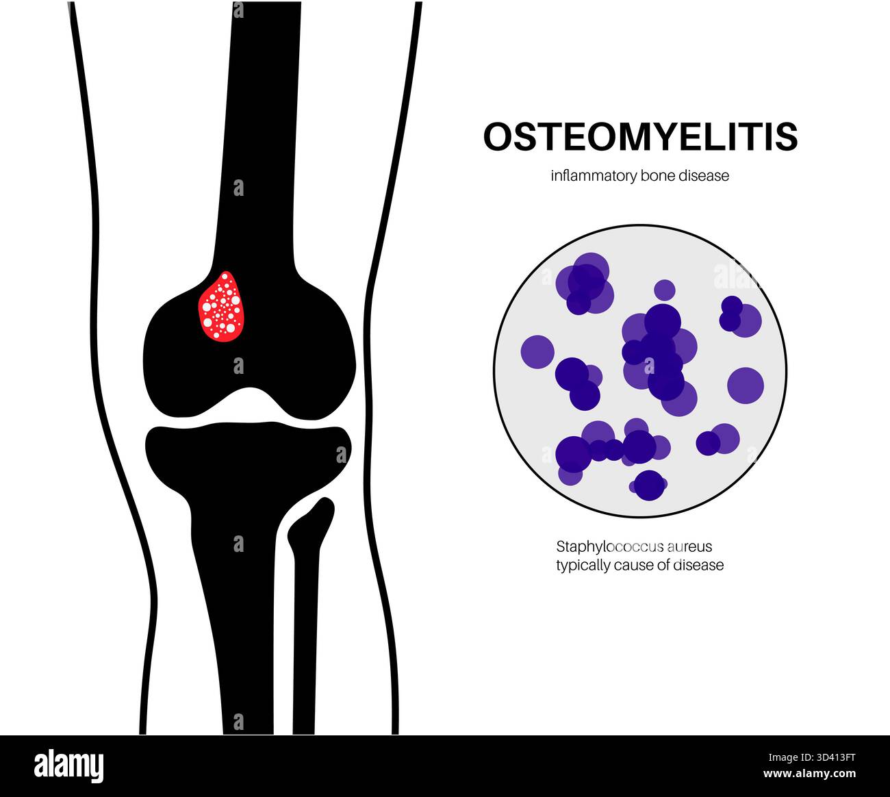 Illustration d'une ostéomyélite osseuse du tibia. Il s'agit d'une infection de l'os du tibia, généralement causée par la bactérie Staphylococcus aureus. Banque D'Images