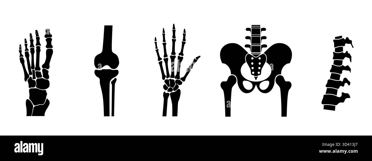 Illustration d'ostéomyélite. Il s’agit d’une infection grave qui se produit lorsque la bactérie infecte la moelle osseuse. Banque D'Images