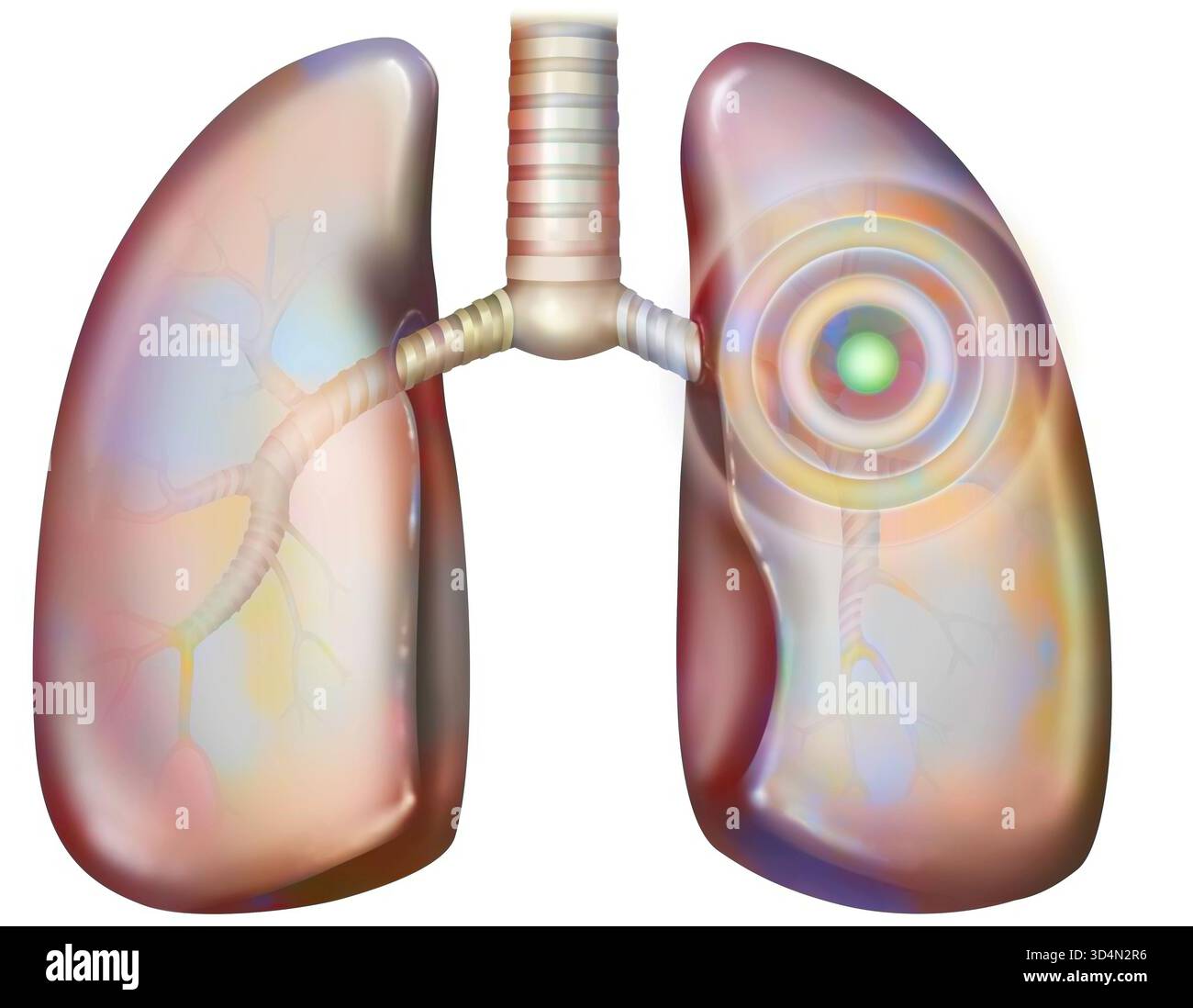 Illustration de pathologies pulmonaires (pneumopathies) : bronchite, pneumonie, embolie, cancer. Banque D'Images
