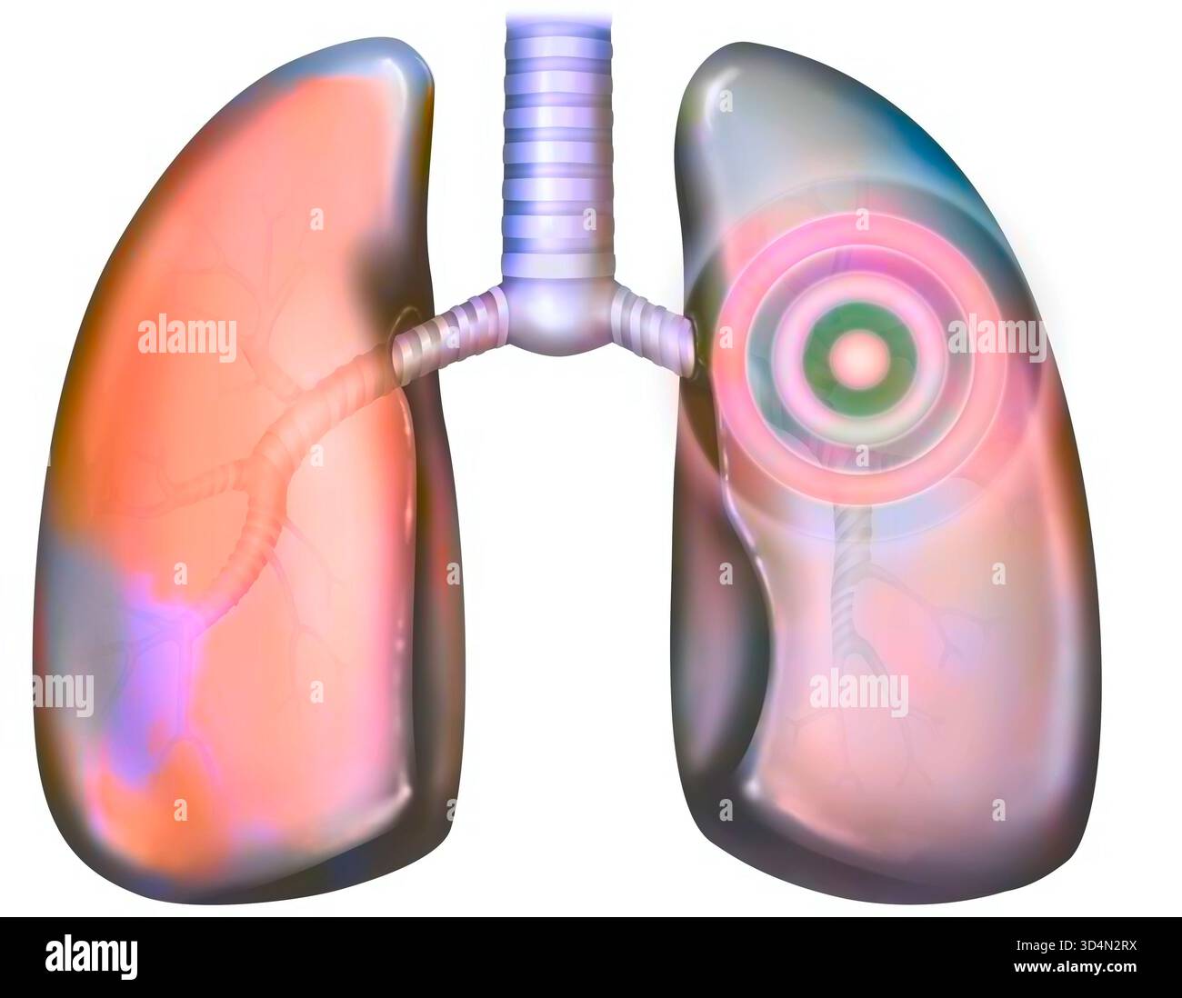 Illustration de pathologies pulmonaires (pneumopathies) : bronchite, pneumonie, embolie, cancer. Banque D'Images