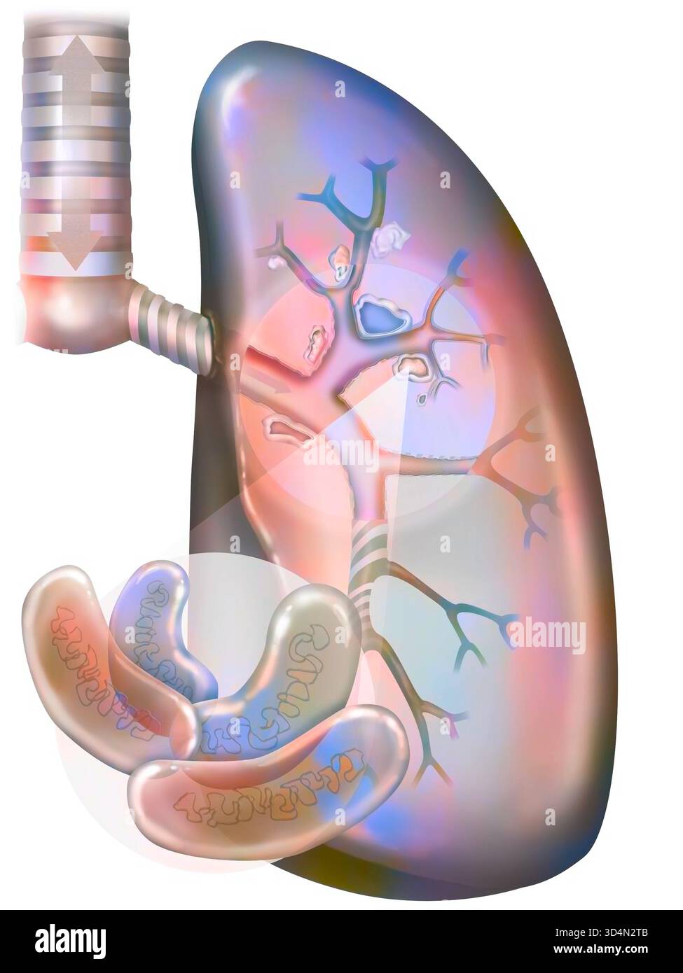 Tuberculose pulmonaire. Les bacilles de Koch colonisent les poumons et se développent, détruisant les tissus, formant des foyers (caseum). Banque D'Images