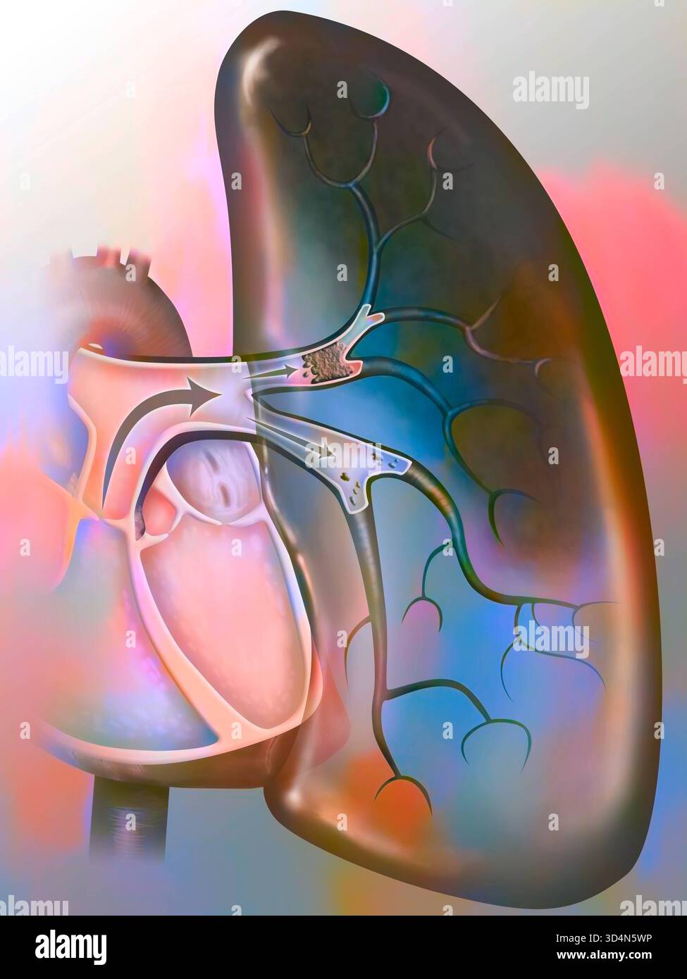 Embolie pulmonaire. Un caillot de sang atteint le cœur et est envoyé, avec le flux sanguin, aux poumons. Etre trop grand pour circuler dans le na de plus en plus Banque D'Images