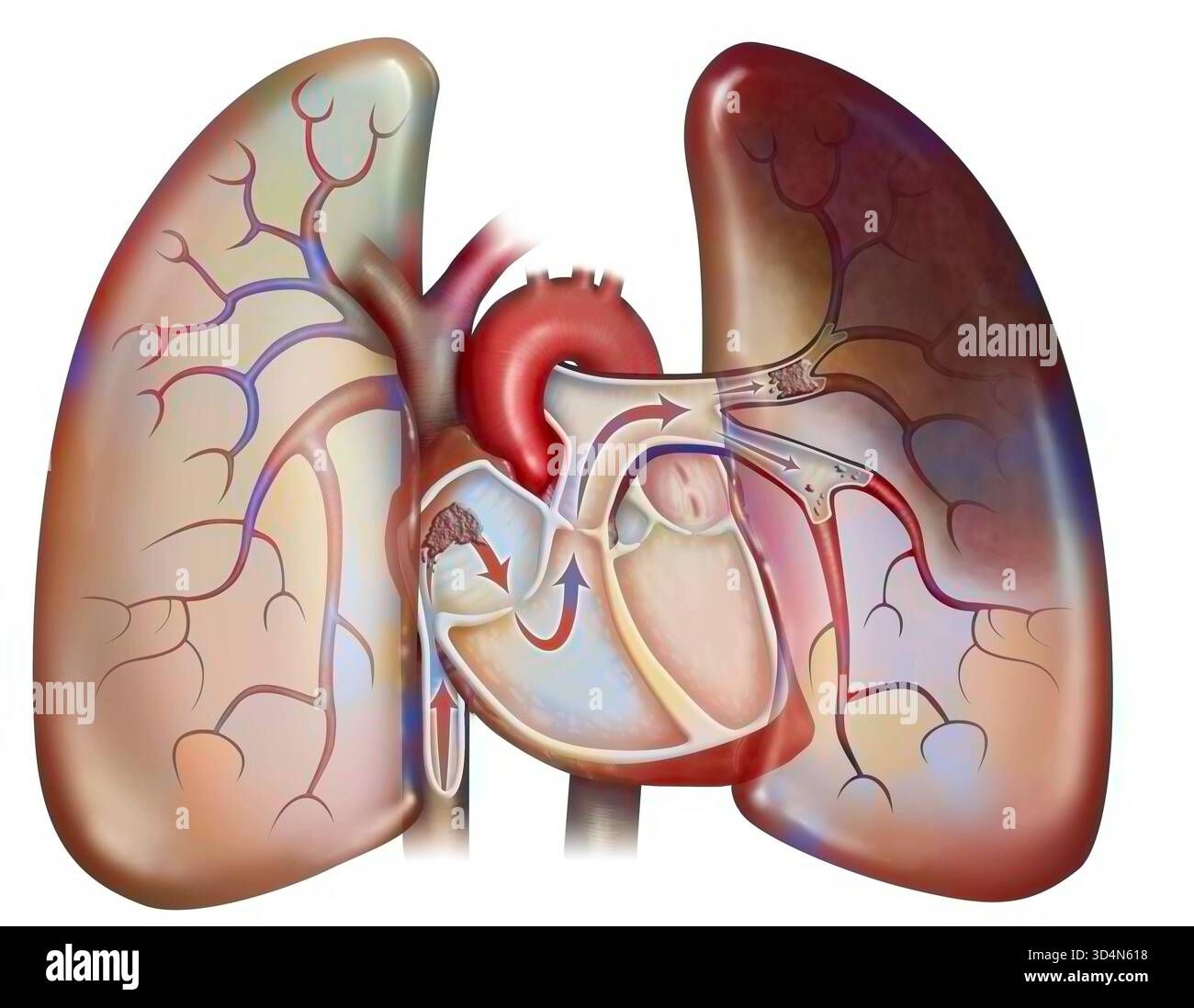 Embolie pulmonaire. Un caillot de sang atteint le cœur par la veine cave et est envoyé, avec le flux sanguin, aux poumons. Etre trop grand pour circuler Banque D'Images
