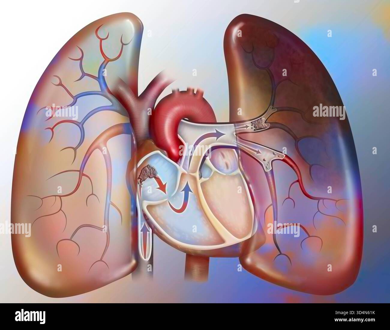 Embolie pulmonaire. Un caillot de sang atteint le cœur par la veine cave et est envoyé, avec le flux sanguin, aux poumons. Etre trop grand pour circuler Banque D'Images