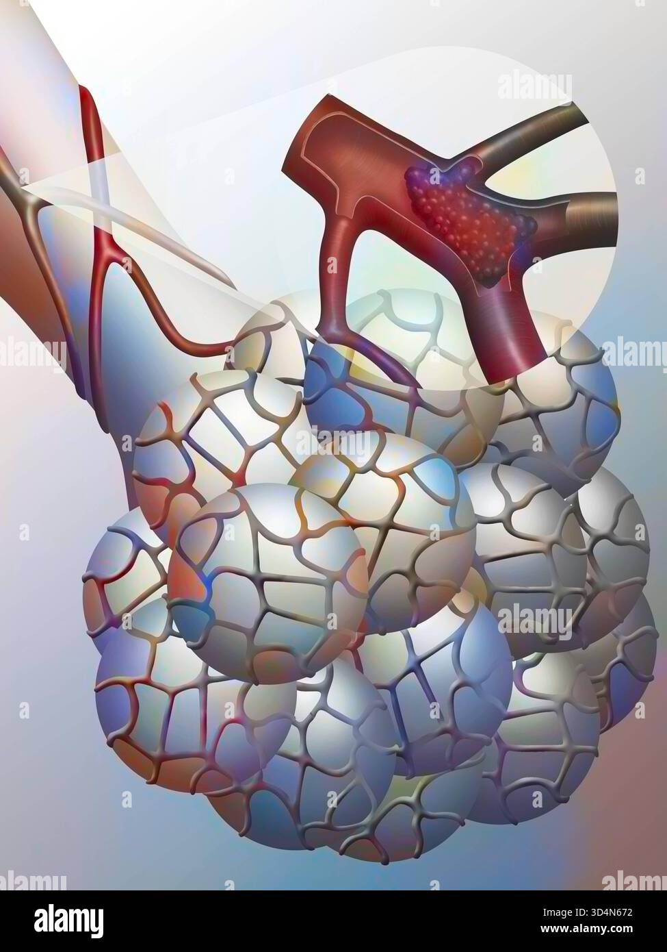 Embolie pulmonaire. Une artériole fournissant une bronchiole terminale est bloquée par un caillot, provoquant une embolie pulmonaire. Si le phénomène est récurrent, t Banque D'Images