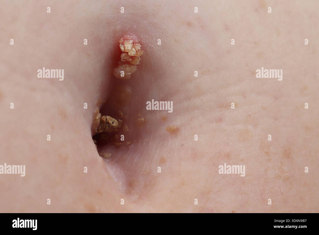 Kératose séborrhéique de l'ombilic chez une femme de 65 ans. Banque D'Images