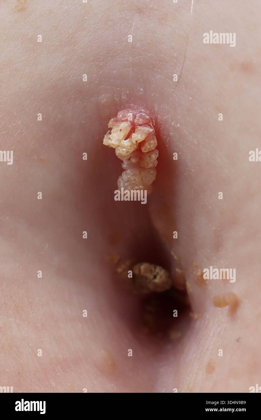 Kératose séborrhéique de l'ombilic chez une femme de 65 ans. Banque D'Images