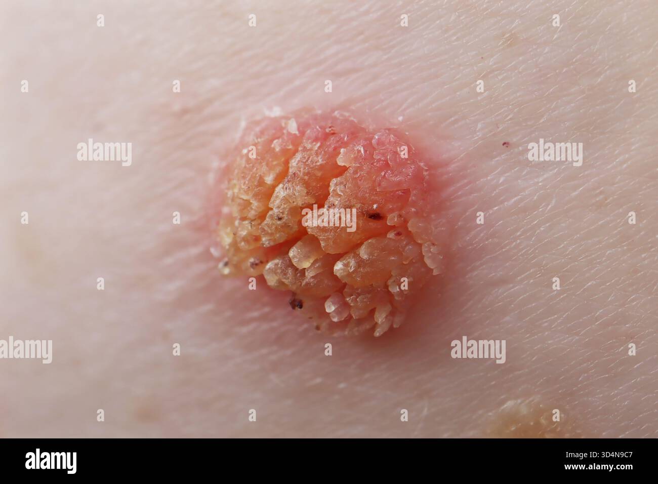 Kératose séborrhéique de l'ombilic chez une femme de 65 ans. Banque D'Images