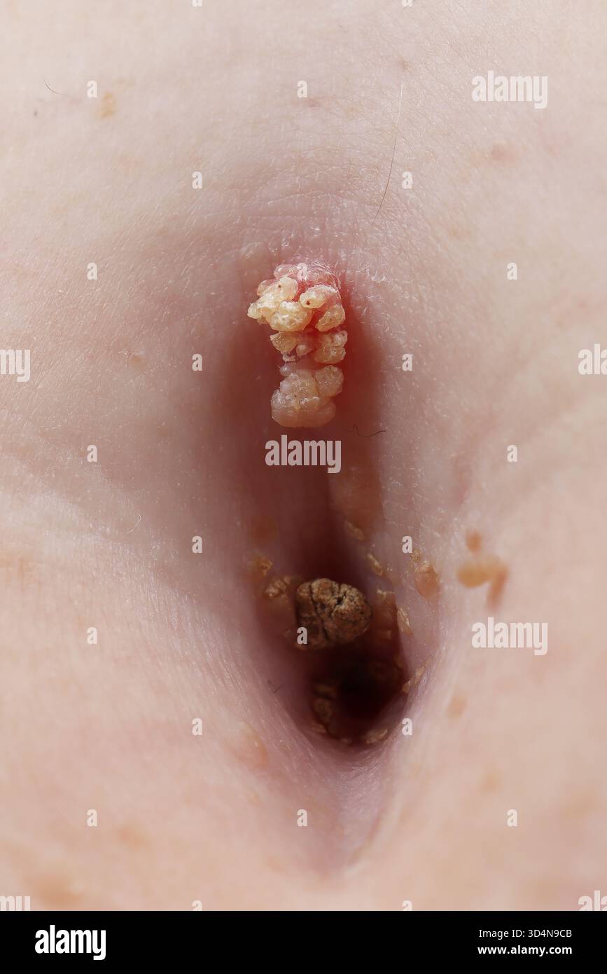 Kératose séborrhéique de l'ombilic chez une femme de 65 ans. Banque D'Images