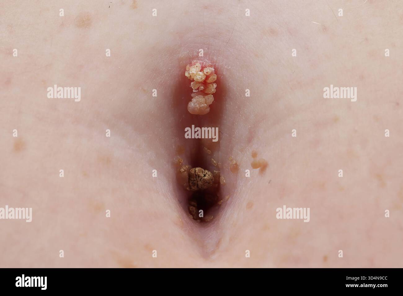 Kératose séborrhéique de l'ombilic chez une femme de 65 ans. Banque D'Images