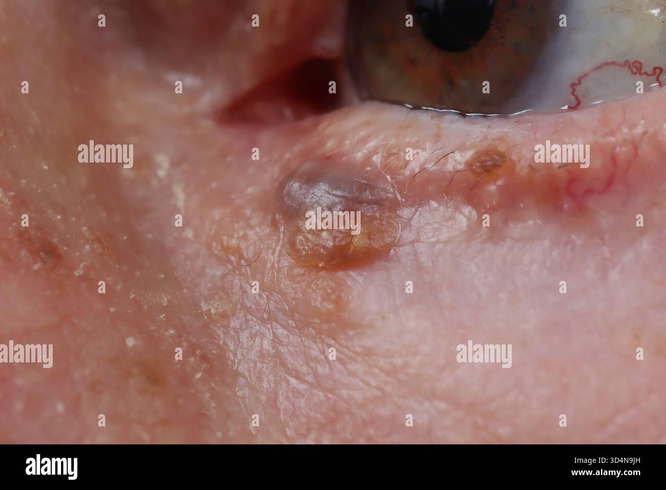 Hidrocystome Bénin de la paupière associé à une kératose séborrhéique chez un homme de 84 ans. Banque D'Images