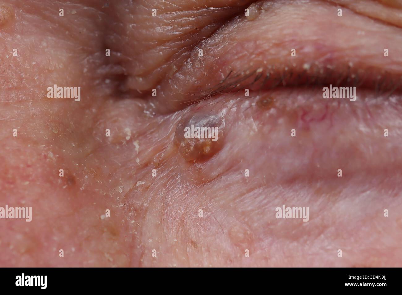 Hidrocystome Bénin de la paupière associé à une kératose séborrhéique chez un homme de 84 ans. Banque D'Images