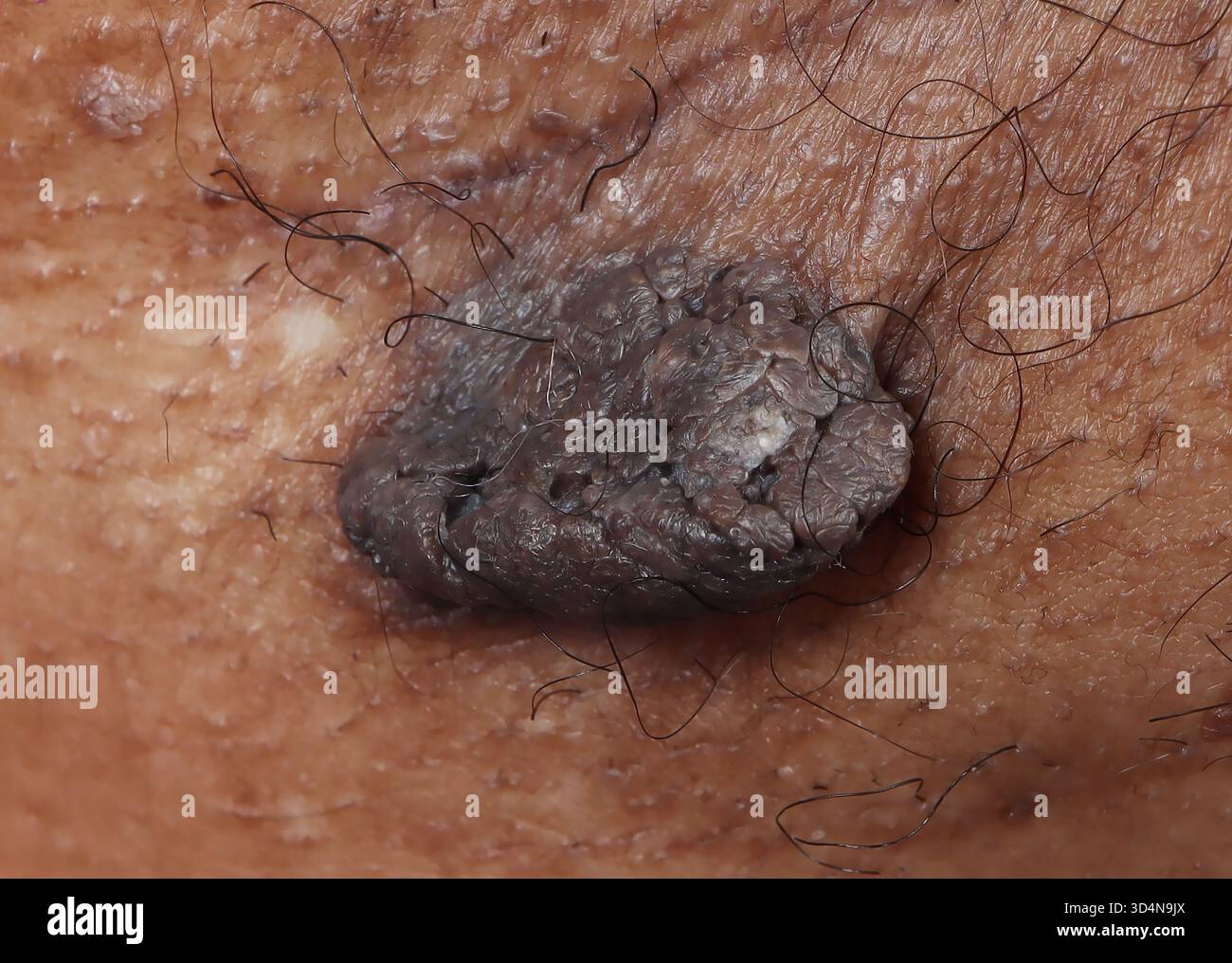 Kératose séborrhéique de l'aisselle chez une femme de 67 ans. Banque D'Images