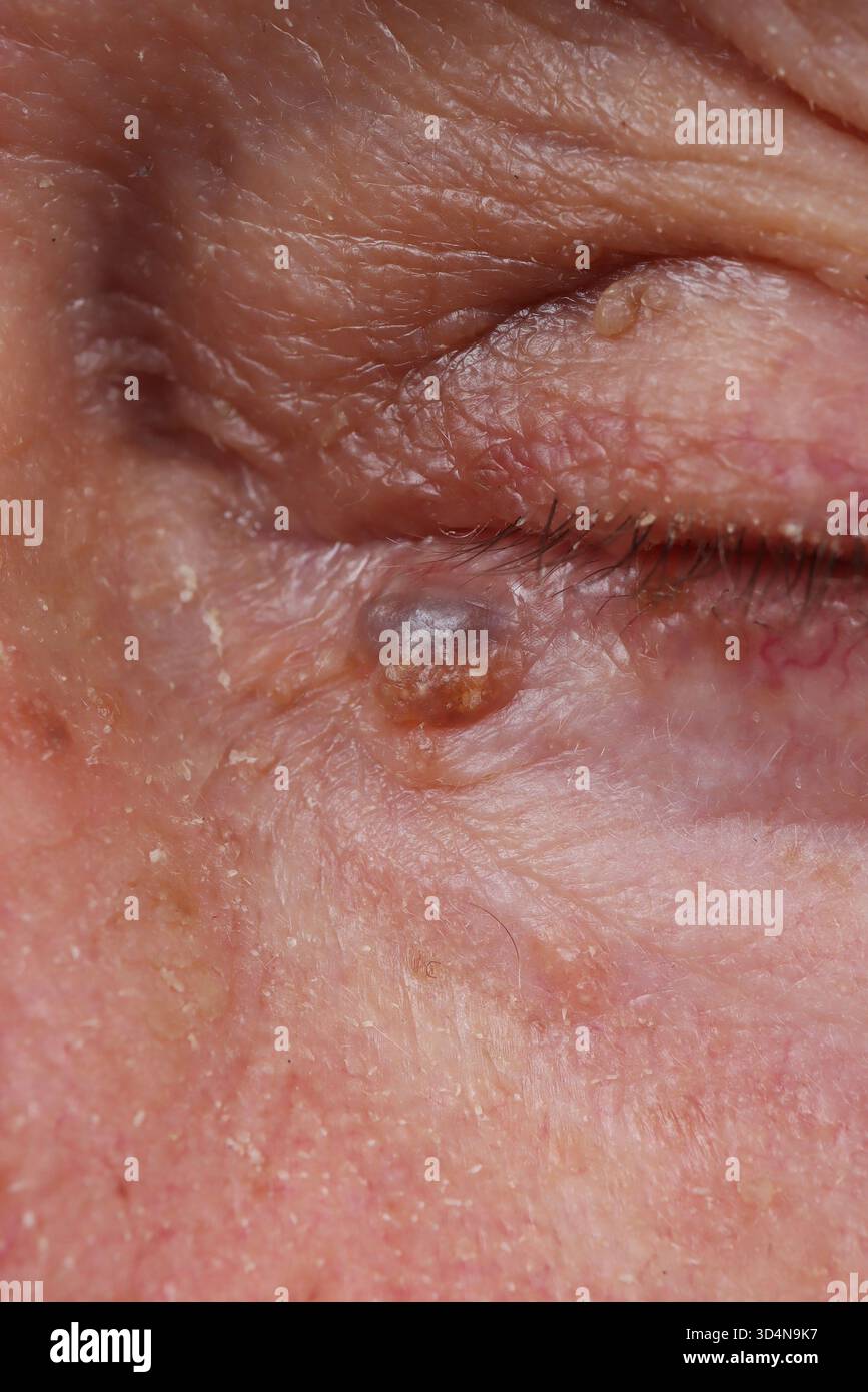 Hidrocystome Bénin de la paupière associé à une kératose séborrhéique chez un homme de 84 ans. Banque D'Images
