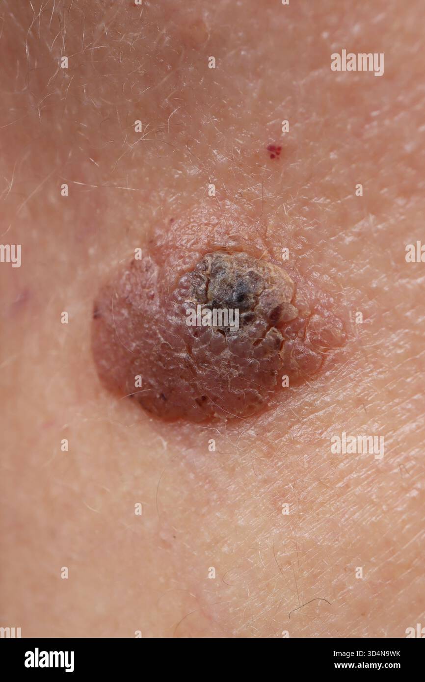 Kératose séborrhéique de la joue chez une femme de 47 ans. Banque D'Images