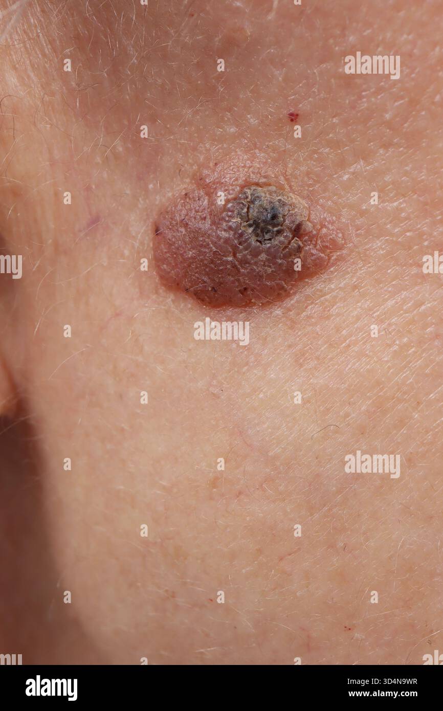 Kératose séborrhéique de la joue chez une femme de 47 ans. Banque D'Images