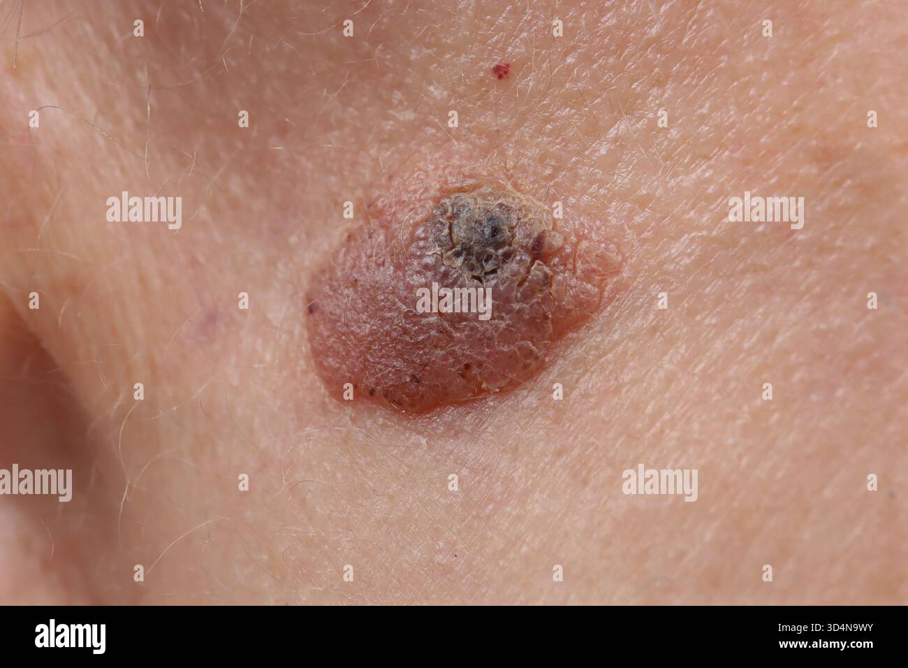 Kératose séborrhéique de la joue chez une femme de 47 ans. Banque D'Images