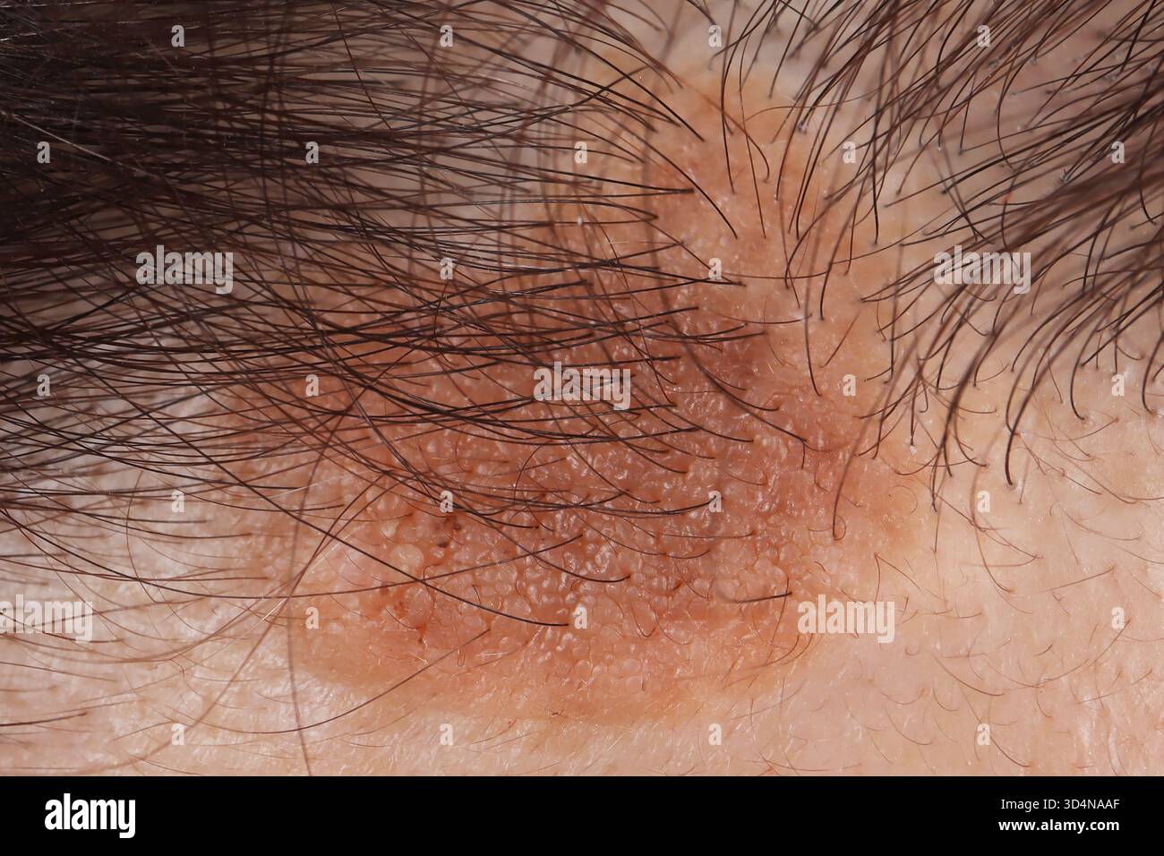 Kératose séborrhéique du front chez une femme de 62 ans. Banque D'Images