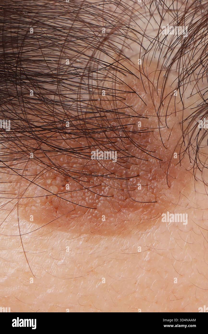 Kératose séborrhéique du front chez une femme de 62 ans. Banque D'Images