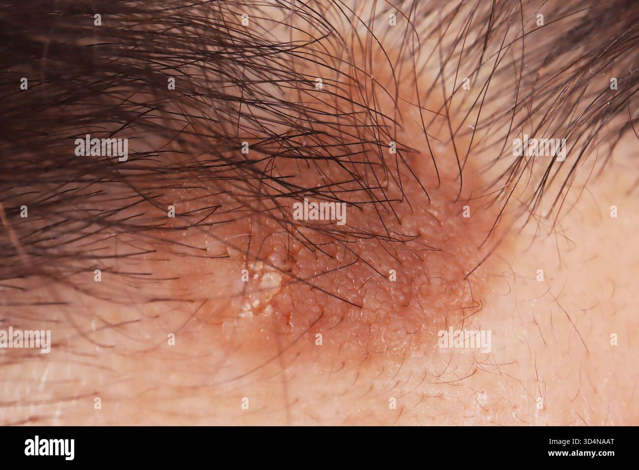 Kératose séborrhéique du front chez une femme de 62 ans. Banque D'Images