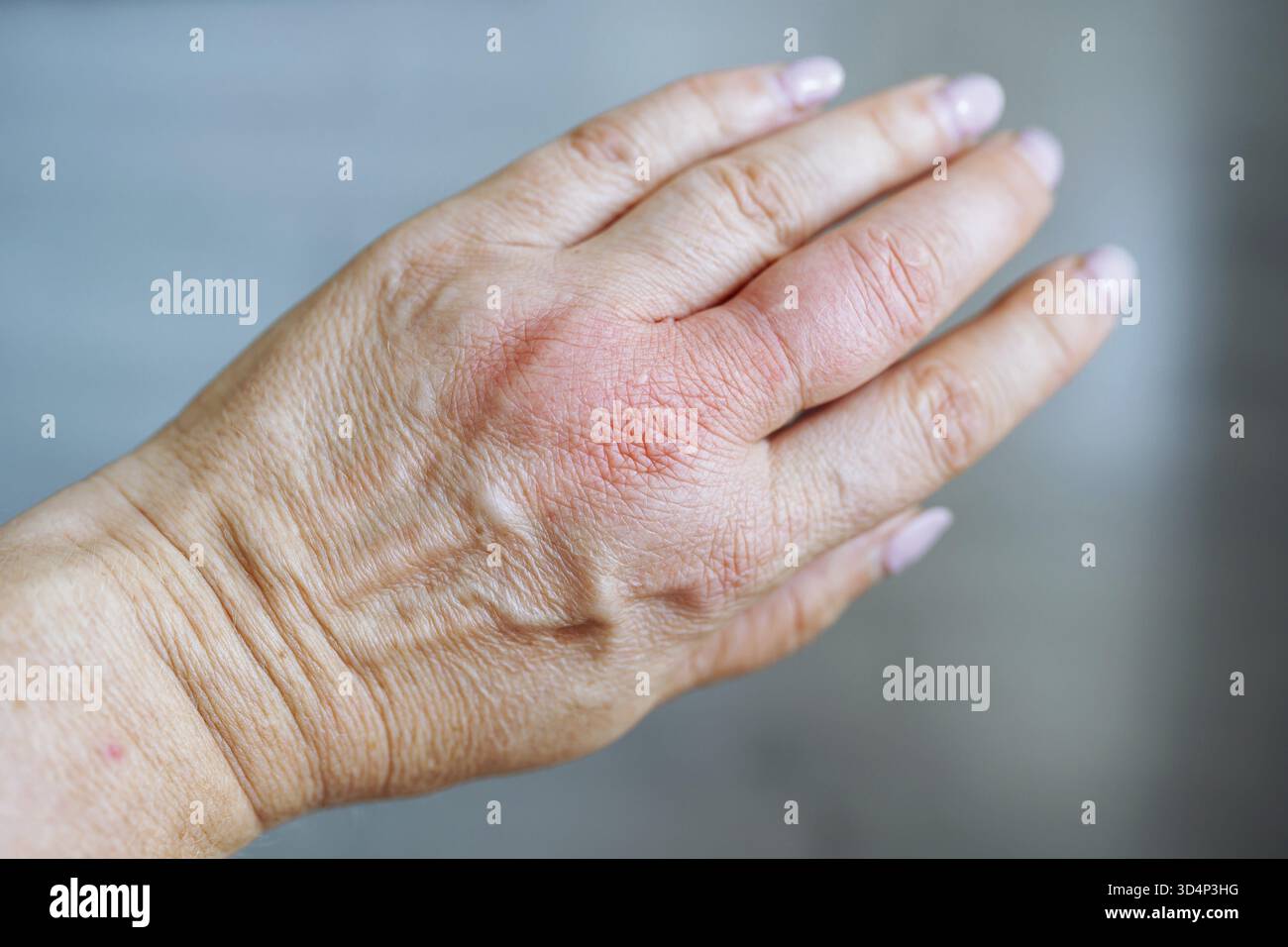 Main gonflée par piqûre de guêpe. doigts gonflés après une piqûre d'insecte, réaction au poison Banque D'Images