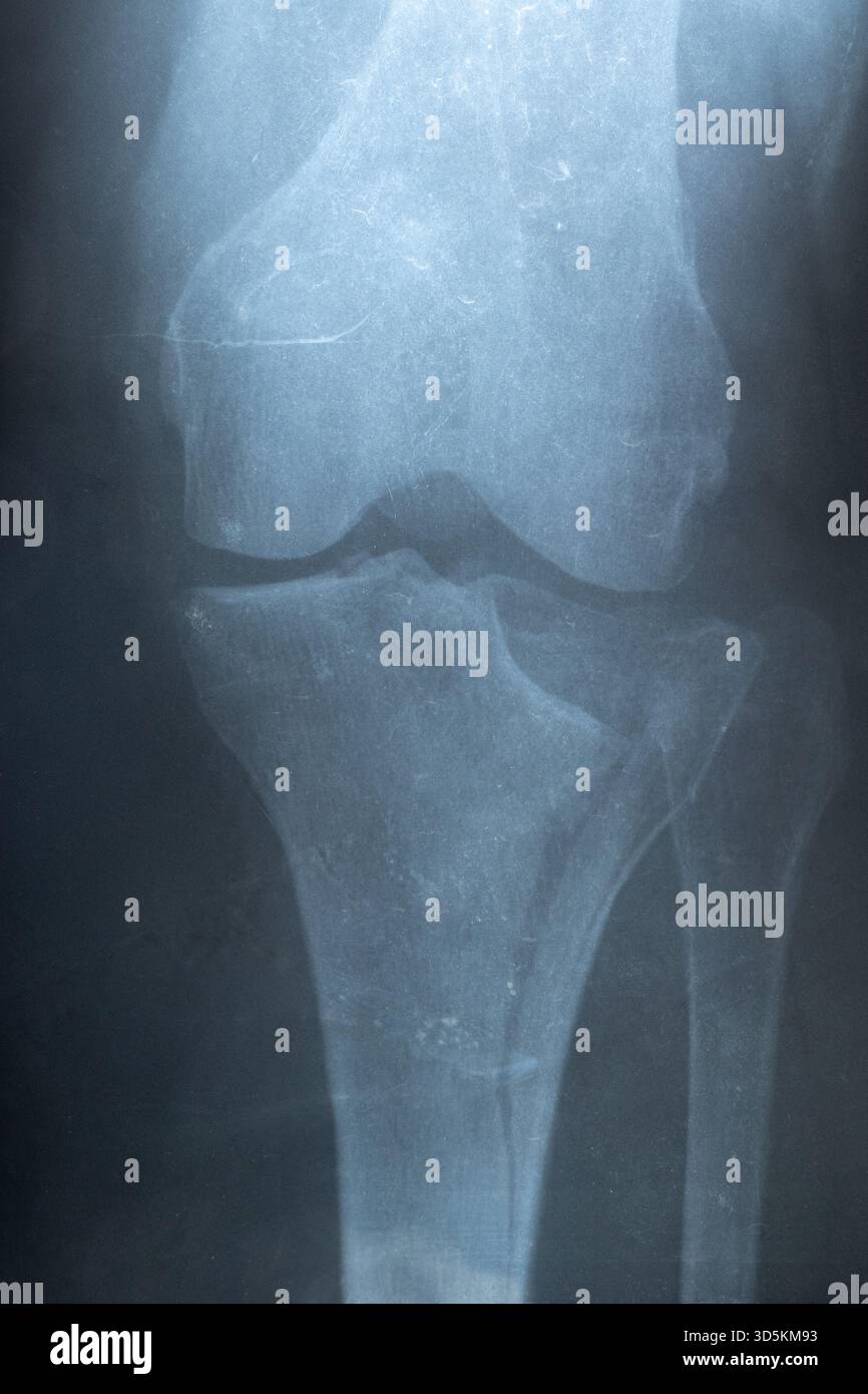 Radiographie de la jambe inférieure d'une femme avec une fracture du tibia subie après une chute d'une chaise, montrant les lignes de blessure et la structure osseuse en gros plan Banque D'Images
