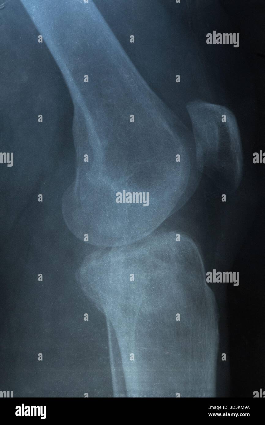 Radiographie de la jambe inférieure d'une femme avec une fracture du tibia subie après une chute d'une chaise, montrant les lignes de blessure et la structure osseuse en gros plan Banque D'Images