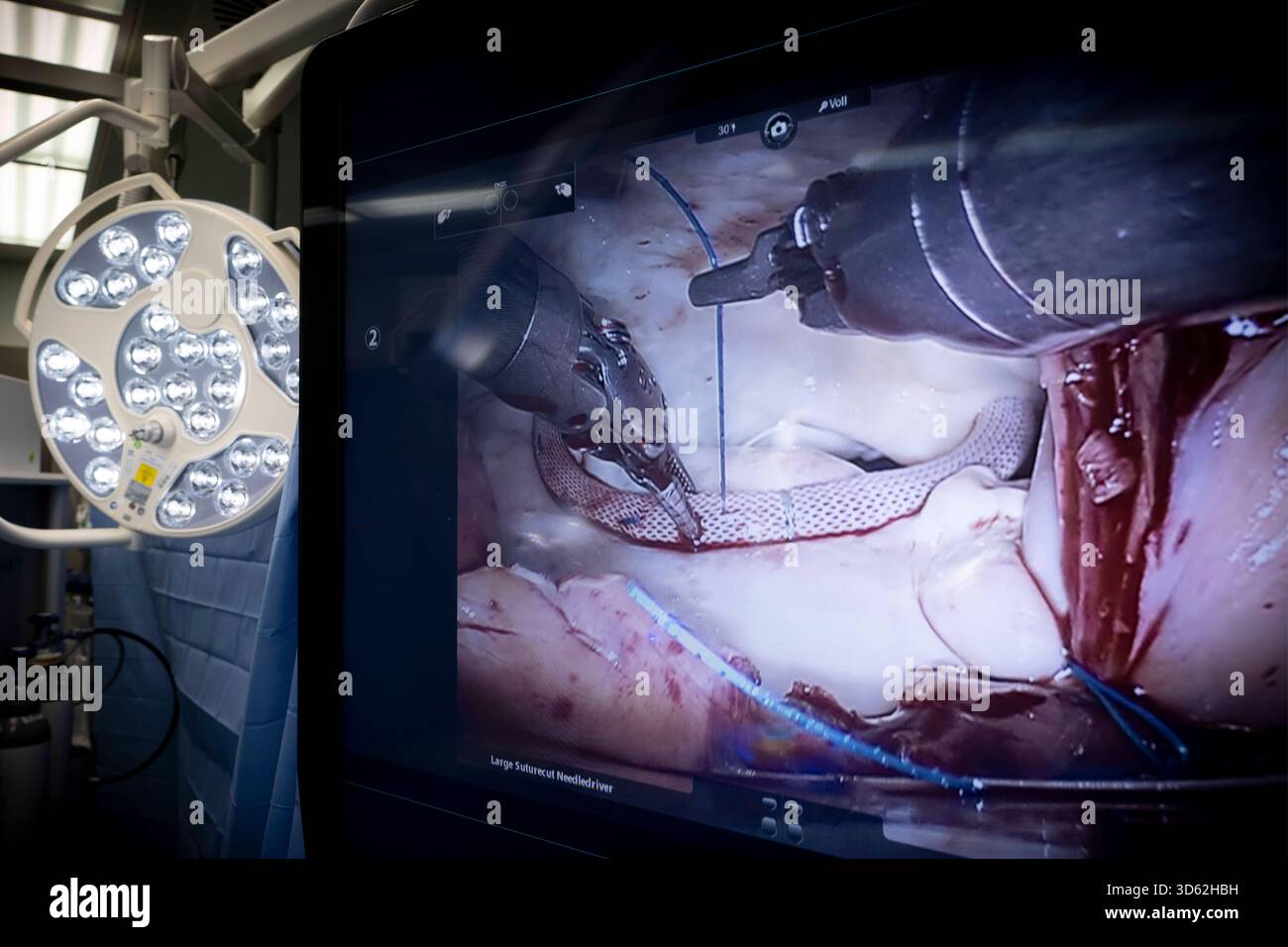Roboter in der Herzchirurgie DEU, Deutschland, Allemagne, Berlin, 12.11.2025 Detail Monitor einer Herzoperation am DHZC , BEI einer Vorfuerung einer robotergestuetzte Operation an Herzklappen vom Da-Vinci-Robotiksystem im Deutschen Herzzentrum im Rudolf-Virchow-Krankenhaus der Berliner Charite in Berlin Deutschland . Die robotergestuetzte chirurgie ist ein modernes Operators Verfahren in der Medizin. SIE ermoeglicht dem Operateur, minimalinvasive Operationstechniken mit Unterstuetzung des roboterassistierten Systems noch exakter und sicherer durchzufuehren als konventionelle minimalinvasive Ope Banque D'Images